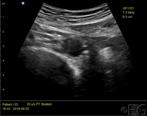 AAW 1a-Left-rectus-abdominal-aorta