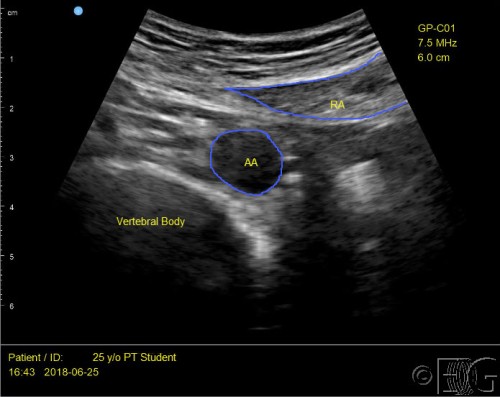 AAW 1b-Left-rectus-abdominal-aorta labeled